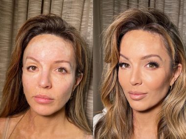 Stalker oblał ją kwasem, jej twarz uratowali śląscy lekarze Katarzyna Dacyszyn